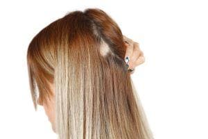 Prótese de cabelo 2
